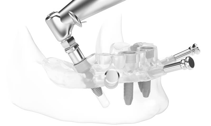 A cirurgia guiada para inserir os implantes dentários no tratamento com dentadura fixa também é conhecida como “cirurgia sem cortes”.