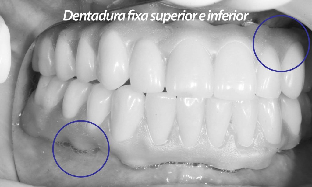 As bordas da dentadura fixa não pressionam as gengivas, mantendo apenas um contato leve para evitar a entrada de alimentos.
