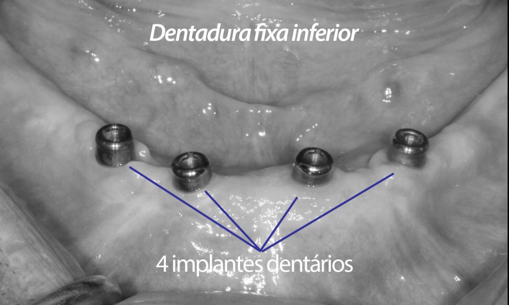 Na arcada inferior, 4 implantes é o número ideal de implantes dentários.