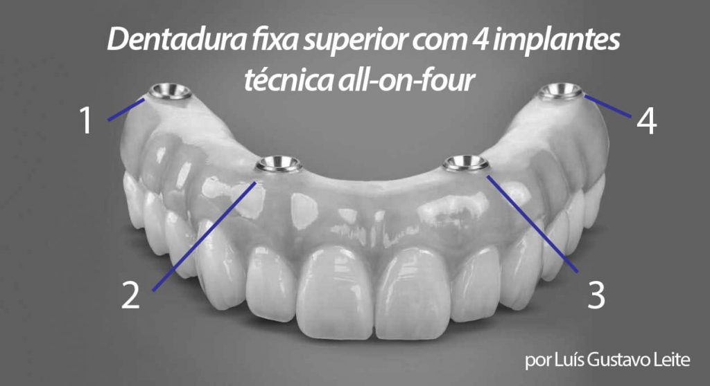 Dentadura fixa: na técnica all-on-four, apenas 4 implantes dentários são necessários para suportas a prótese dentária.