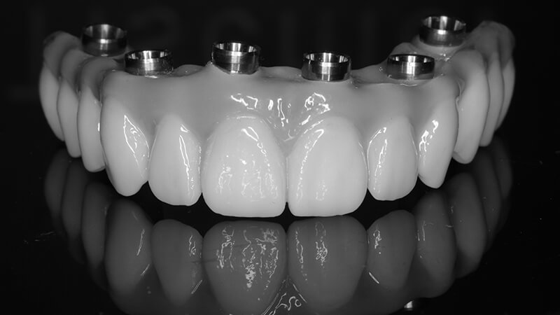 Dentadura fixa em porcelana sobre estrutura interna em metal: resultados estéticos marcantes e maior durabilidade.
