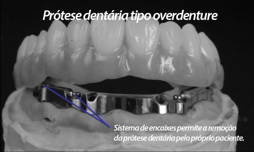 Prótese overdenture é técnica que permite a remoção da prótese dentária pelo próprio paciente, facilitando a limpeza.