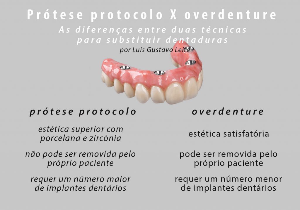 Prótese protocolo é uma versão de dentadura sobre implantes dentários que pode ser removida pela próprio paciente.