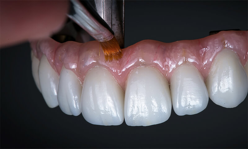 Dentadura fixa: pintura e personalização das gengivas em porcelana é uma das vantagens deste tipo de prótese protocolo.
