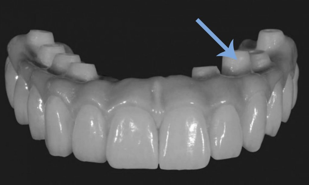 Dentadura fixa, ou prótese protocolo, em porcelana sobre zircônia. No detalhe, as conexões em zircônia que entram em contato com os implantes dentários.