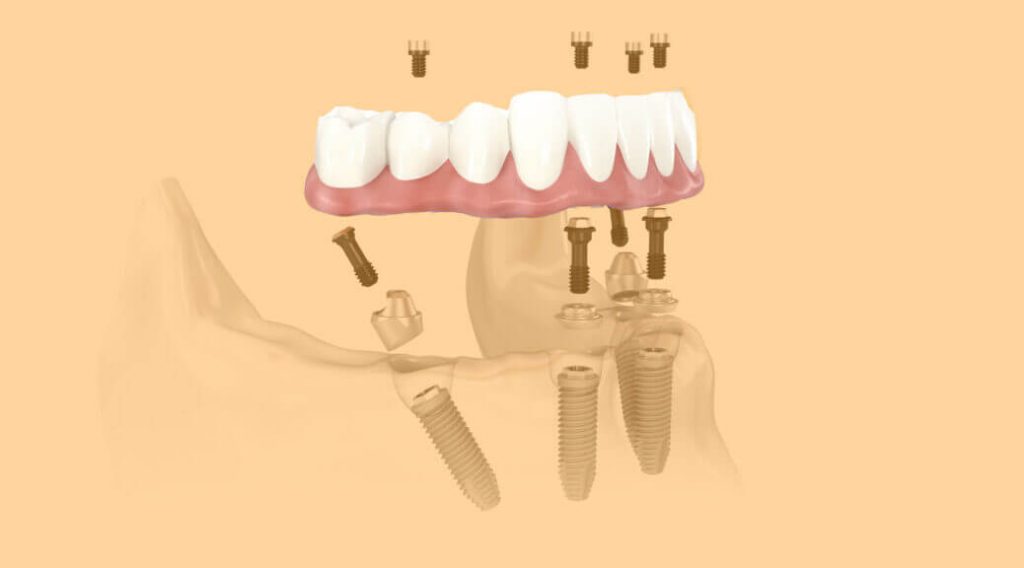 O tratamento com dentadura fixa: o que é, quem pode fazer, quais os prós e contras e outras informações essenciais para recuperar a estética e mastigação na técnica com prótese protocolo.